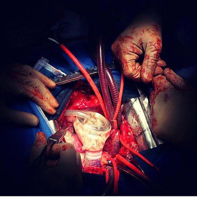 CardioWest Artificial Heart