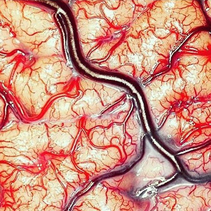 Cerebrovascular accident