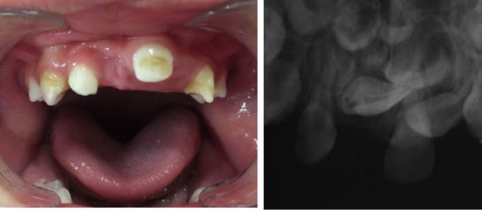Prior History of Trauma Can Damage Teeth Before Eruption