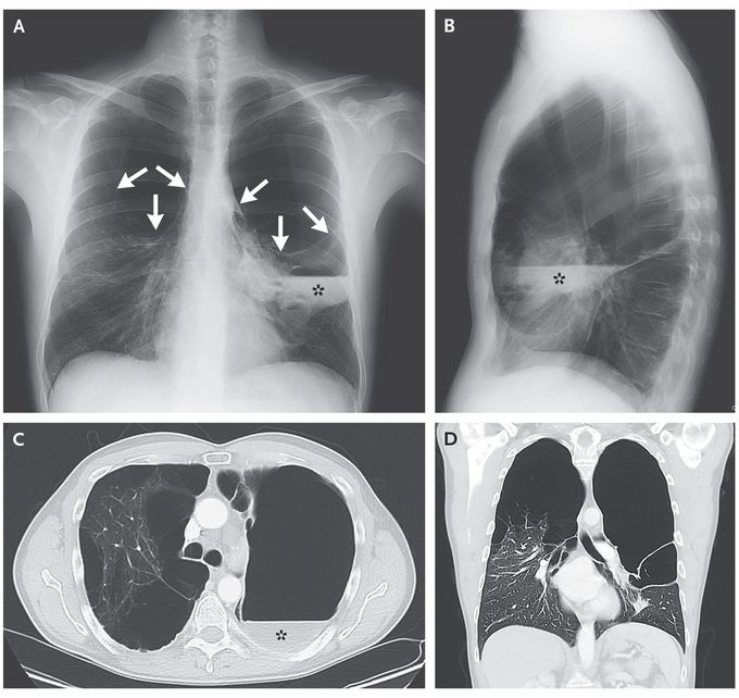 Vanishing Lung Syndrome