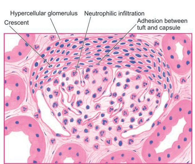 Rapidly progressive glomerulonephritis