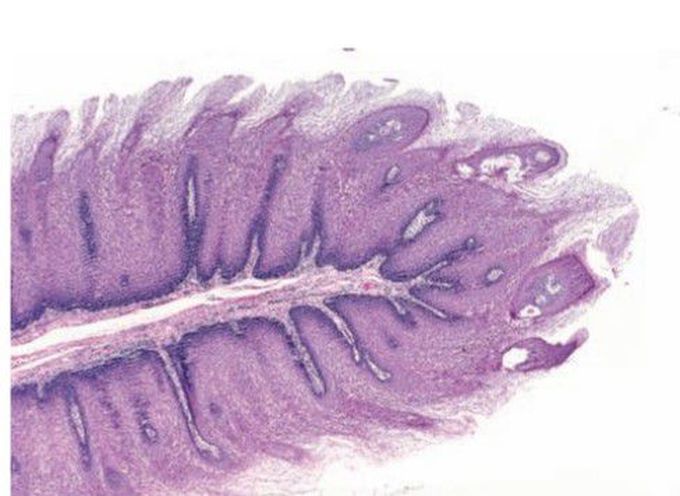 Papilloma histopathology