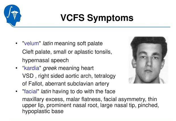 These are the symptoms of velocardialfacial syndrome - MEDizzy