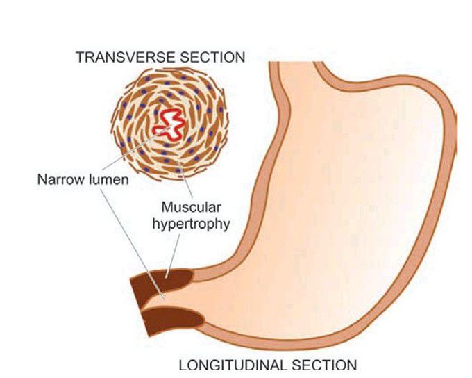 Pyloric stenosis, infantile type.