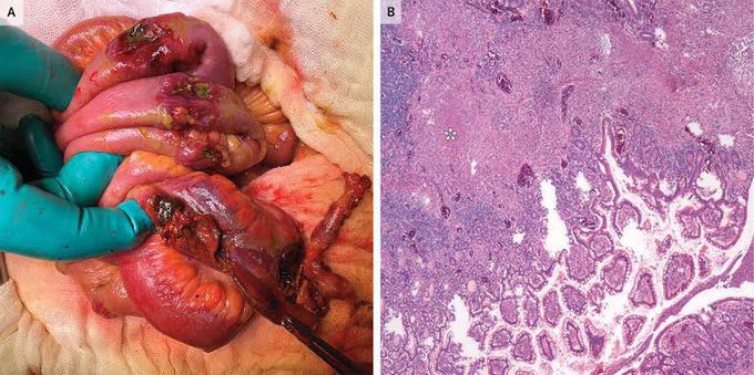 Intestinal tuberculosis