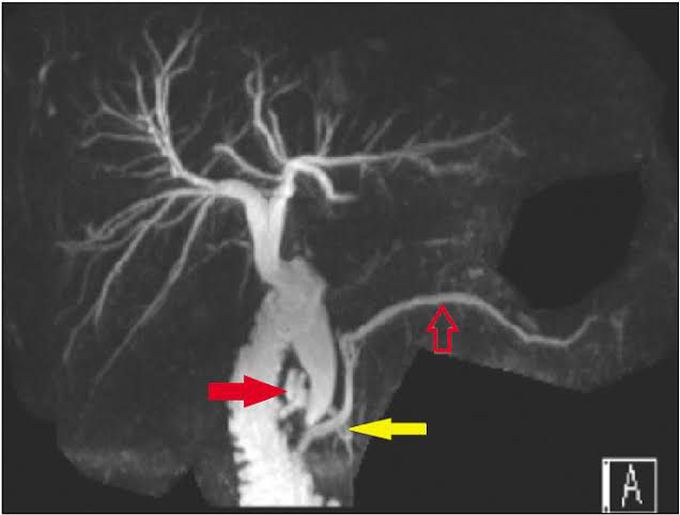 Magnetic resonance cholangiopancreatography