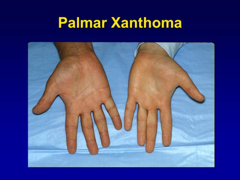 Plane Xanthoma