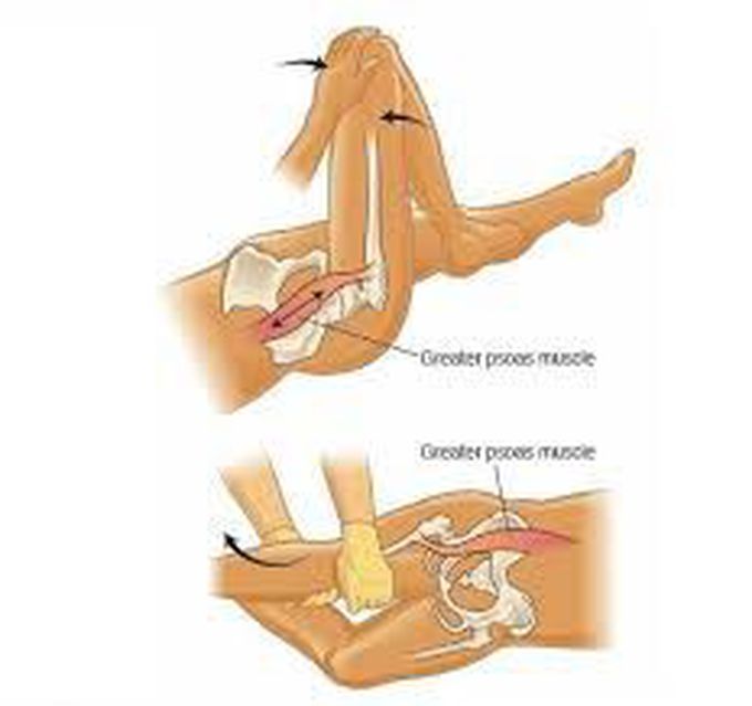 Psoas sign