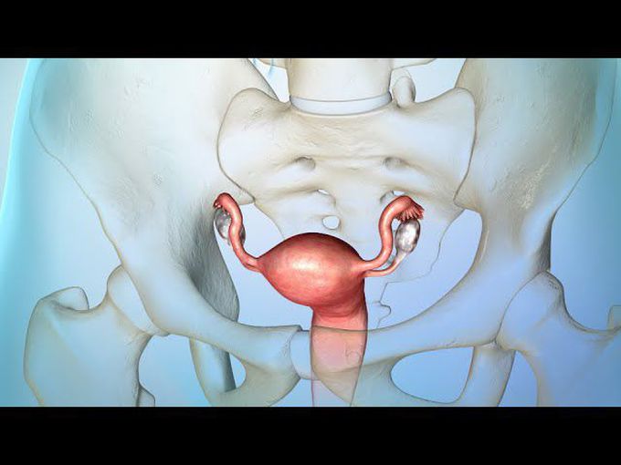 Managing Ovarian Cancer