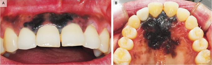 Intraoral Malignant Melanoma