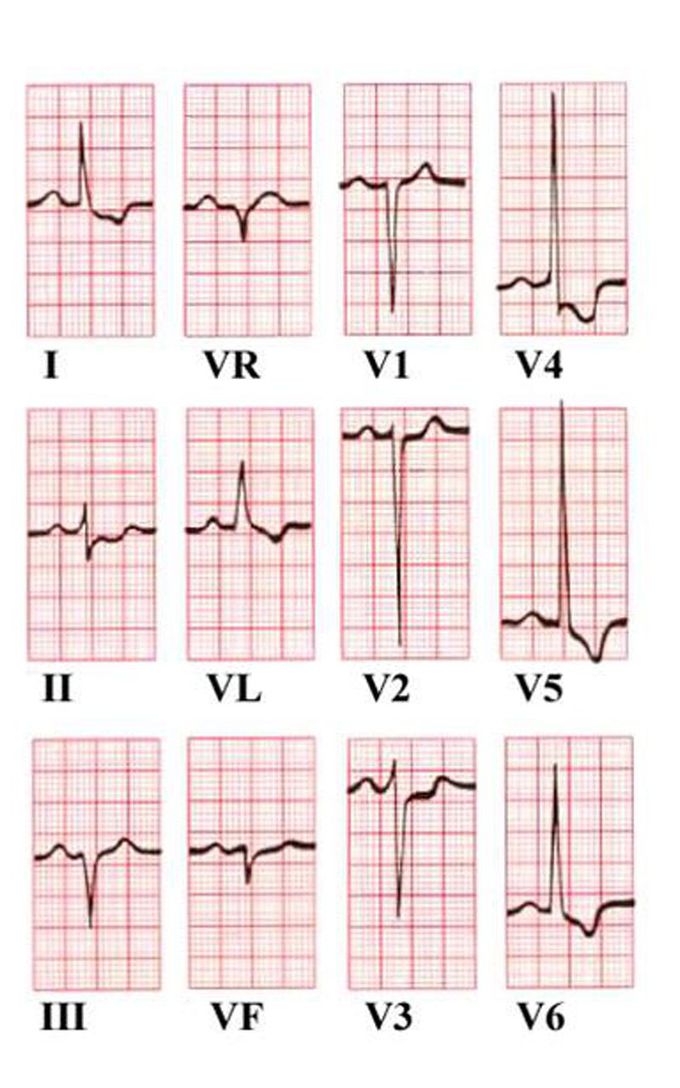 Axis  deviation