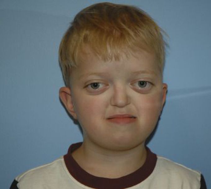 Crouzon syndrome