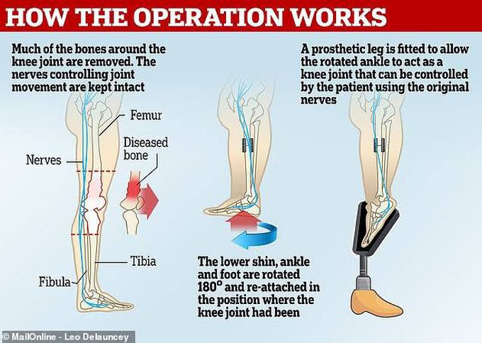 Rotationalplasty