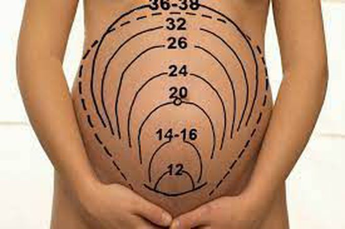 Etiology of Large Fundal Height