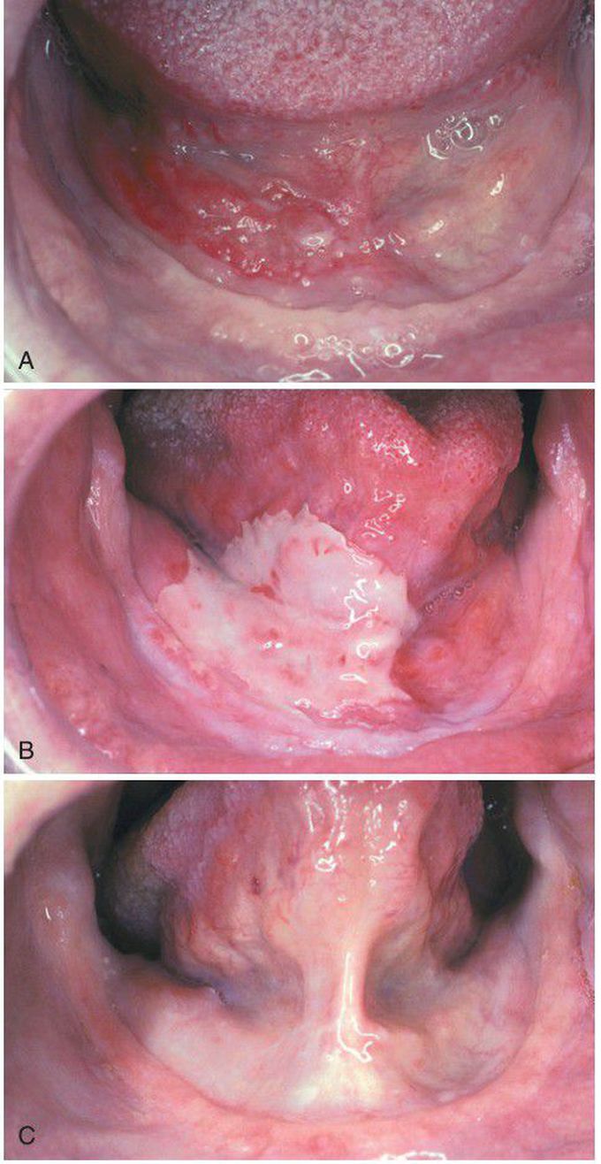 Radiation Mucositis.