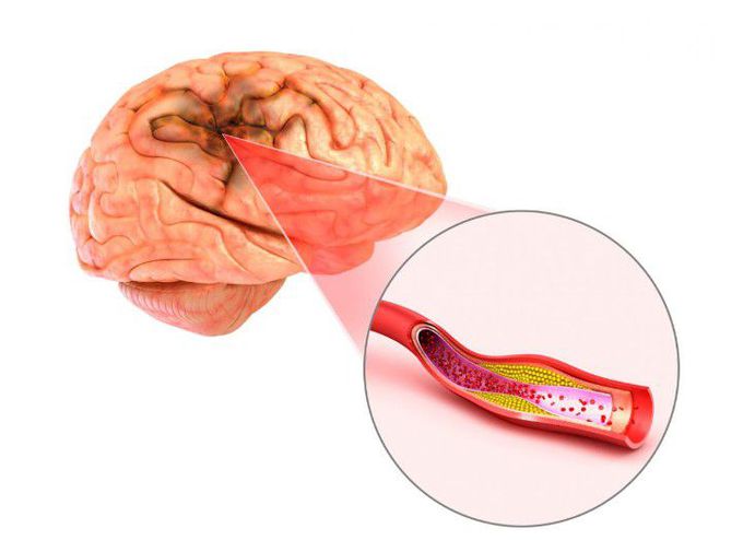 Cerebral aneurysm treatment options