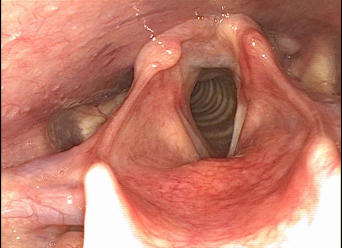 Laryngeal malformation?