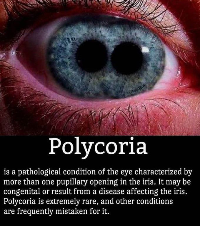 Polycoria - A pathological condition of the eye characterized by more than 1 pupillary opening in iris .