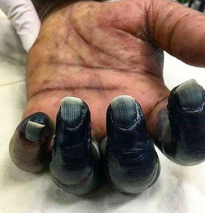 Ischemic necrosis and gangrene of fingers