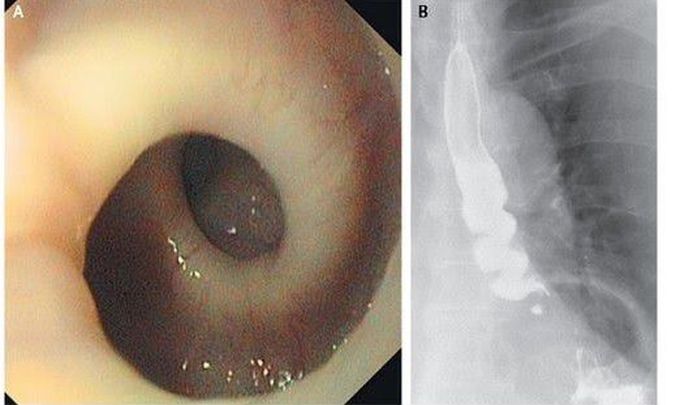 "Twisted Esophagus"