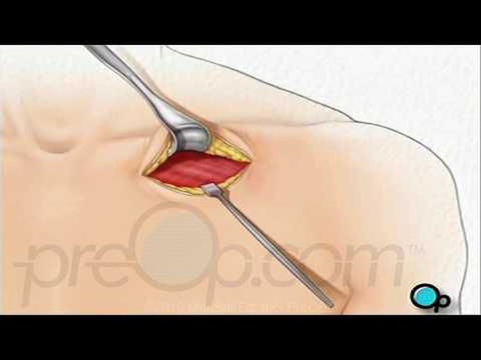 Pacemaker implant surgery