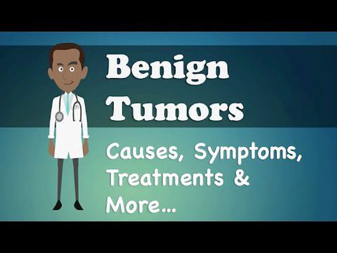 Basic pathology of benign tumours.