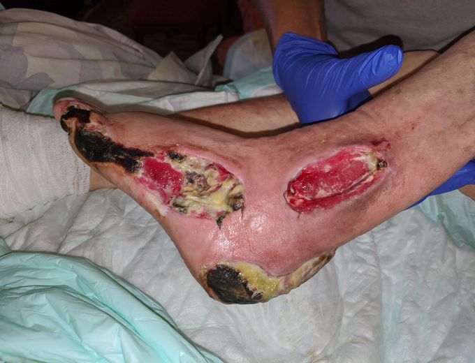 Debridement