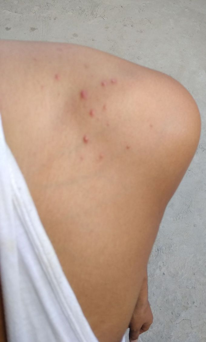 Reddish allergy type