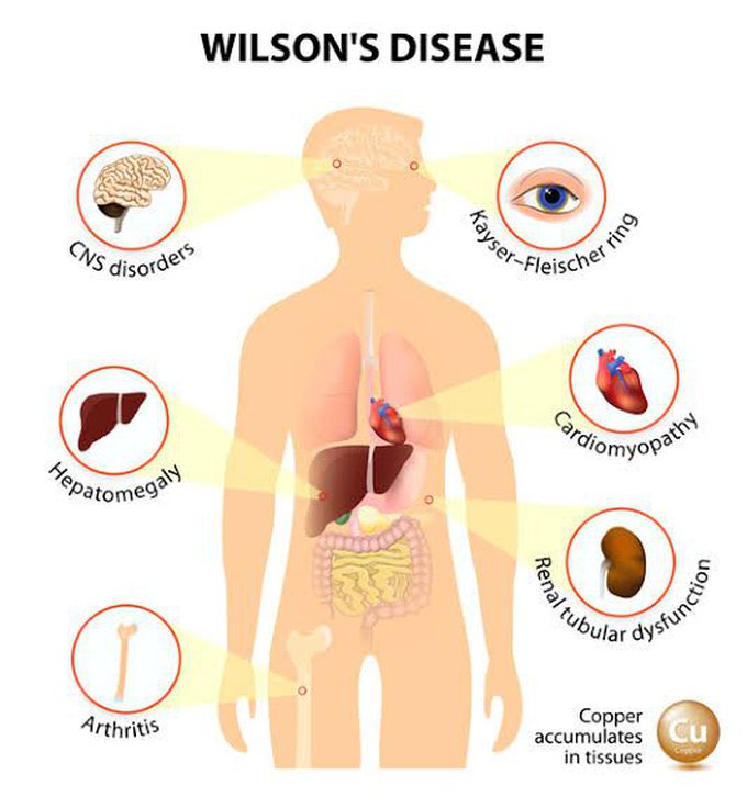 These are the symptoms of Wilsons syndrome