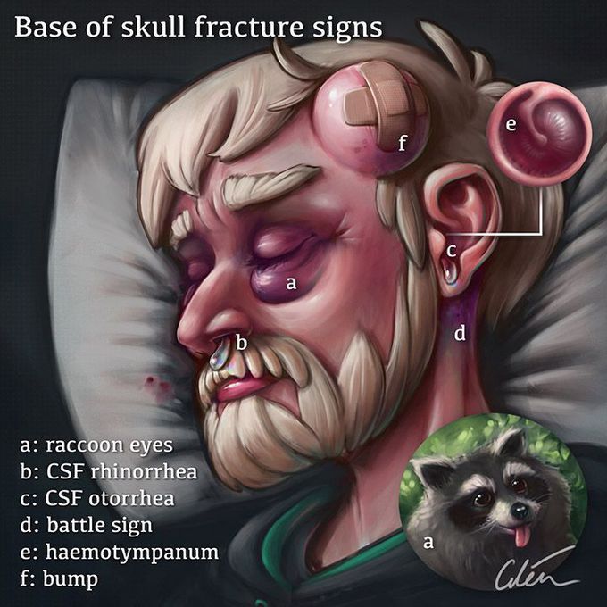 Base of Skull 💀 fracture signs