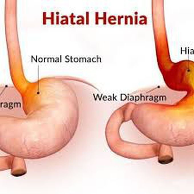 Hiatal hernia