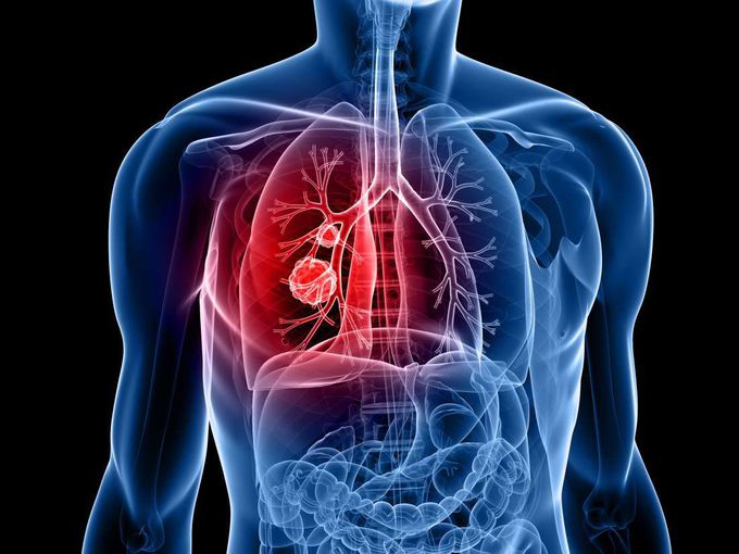 New protein may help to catch lung cancer early