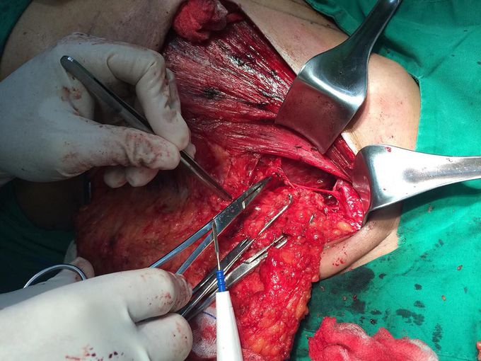 Nerves preservation on modified radical mastectomy 