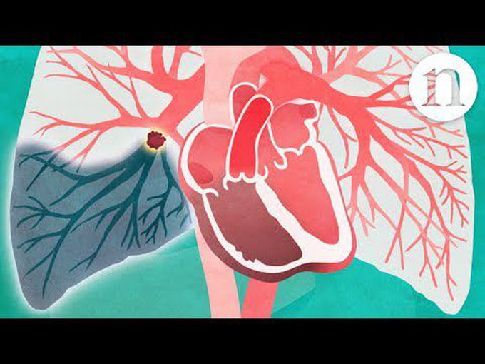 Pulmonary embolism-Animation