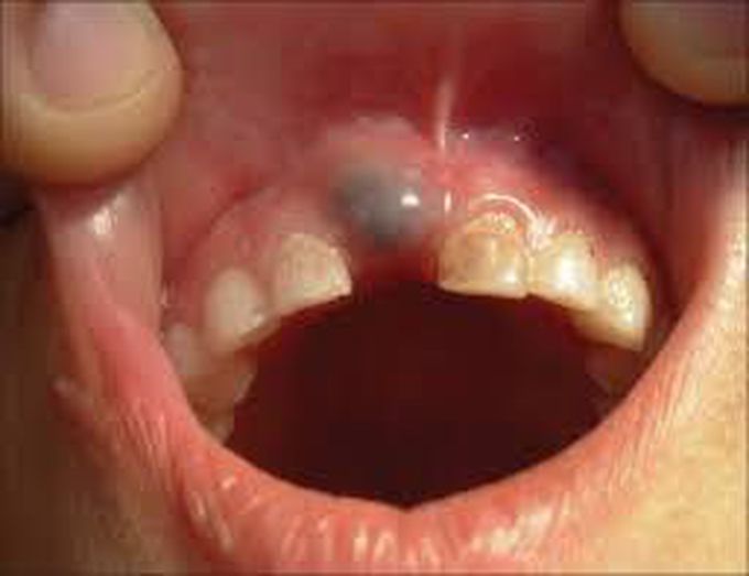 Eruption cyst