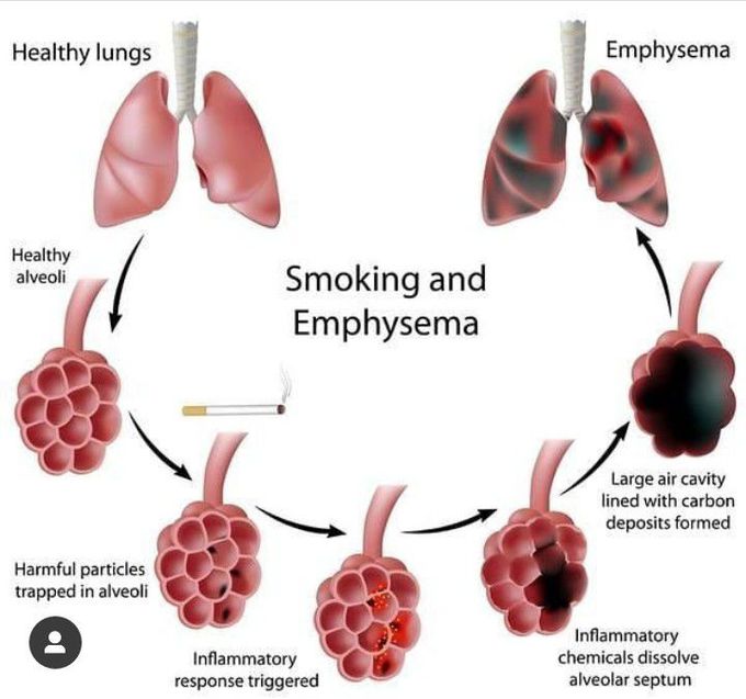 Lungs Emphysema