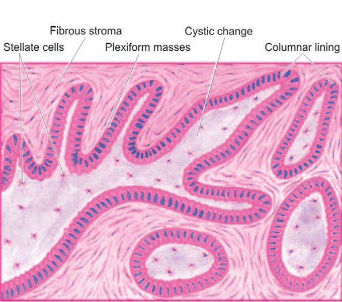 Ameloblastoma