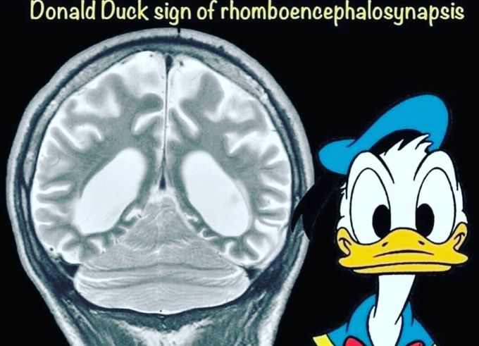 DONALD DUCK SIGN OF RHOMBENCEPHALOSYNAPSIS.