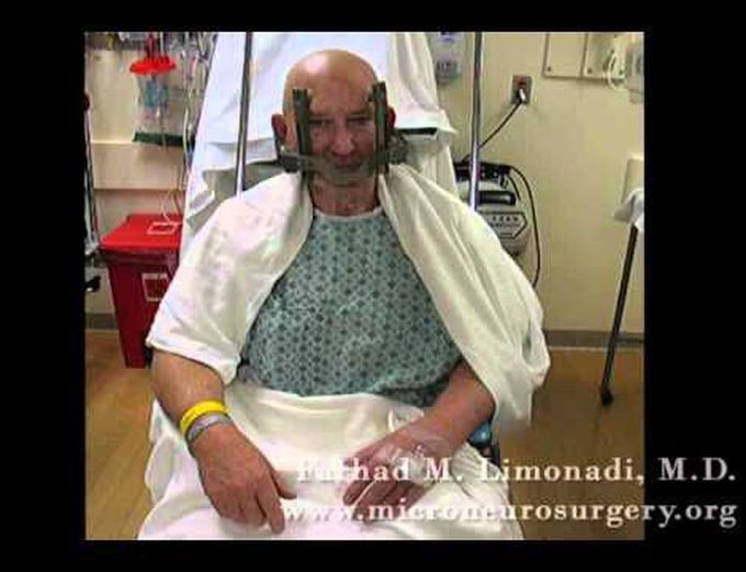 Parkinson's disease: Implantation of DBS (Deep Brain Stimulator) Awake Brain Surgery