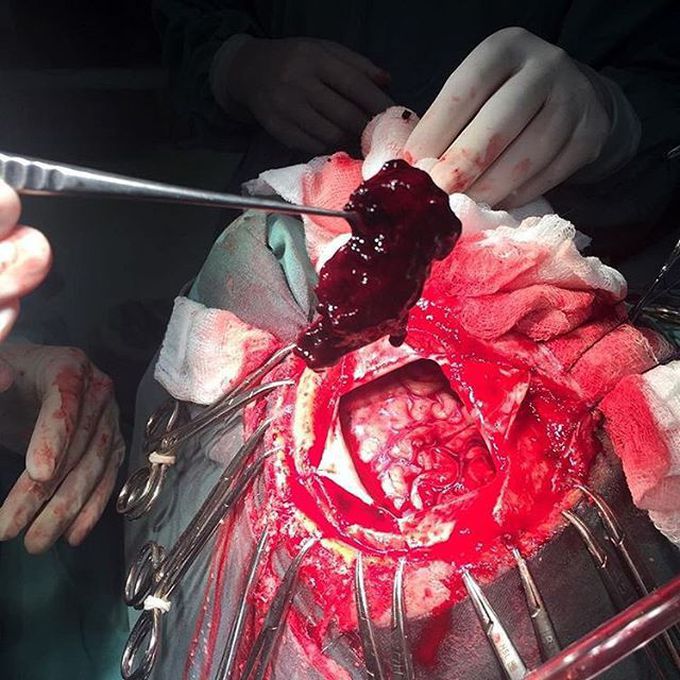 An acute subdural hematoma in a 85-year-old male patient who suffered a traumatic brain injury!  