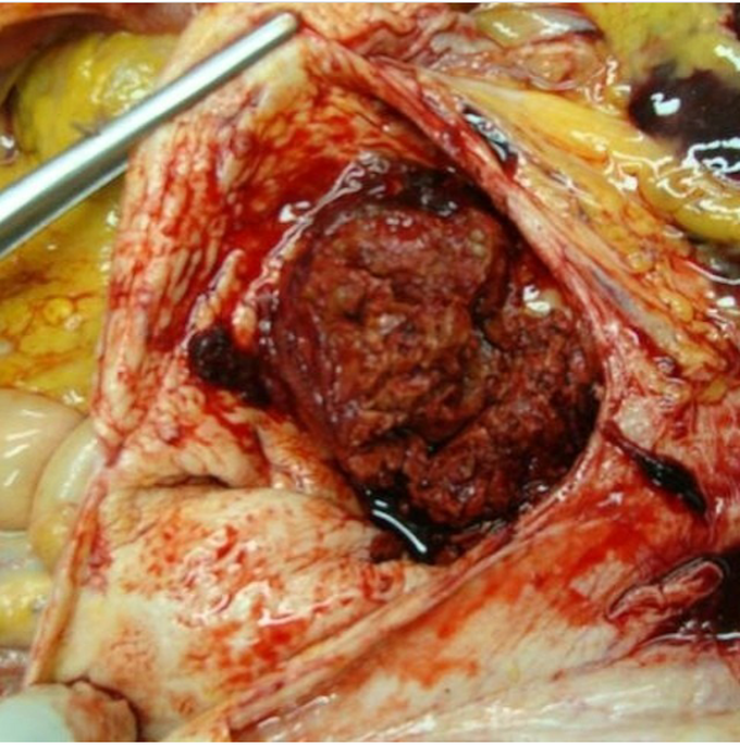 Aortic aneurysm with a large thrombus.