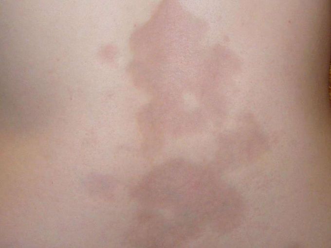 Morphea: Symptoms, causes, and treatment