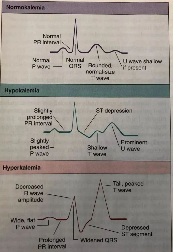 K Changes and ECG
