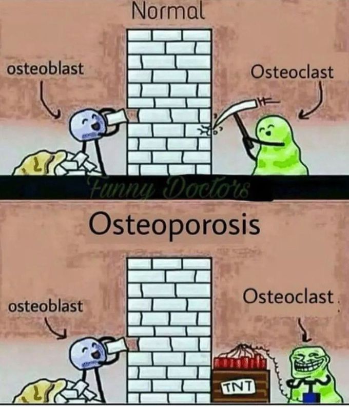 Normal Bone Vs Osteoporosis