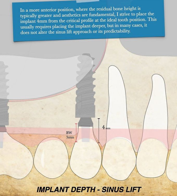 Implant Depth- Anterior Teeth