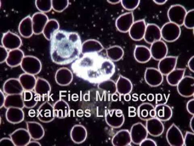 Live blood analysis in darkfield microscopy and its comparison with brightfield microscopy