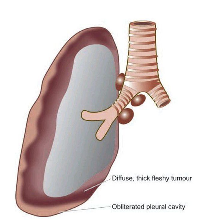 Malignant (diffuse) mesothelioma