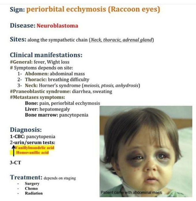 periorbital ecchymosis neuroblastoma