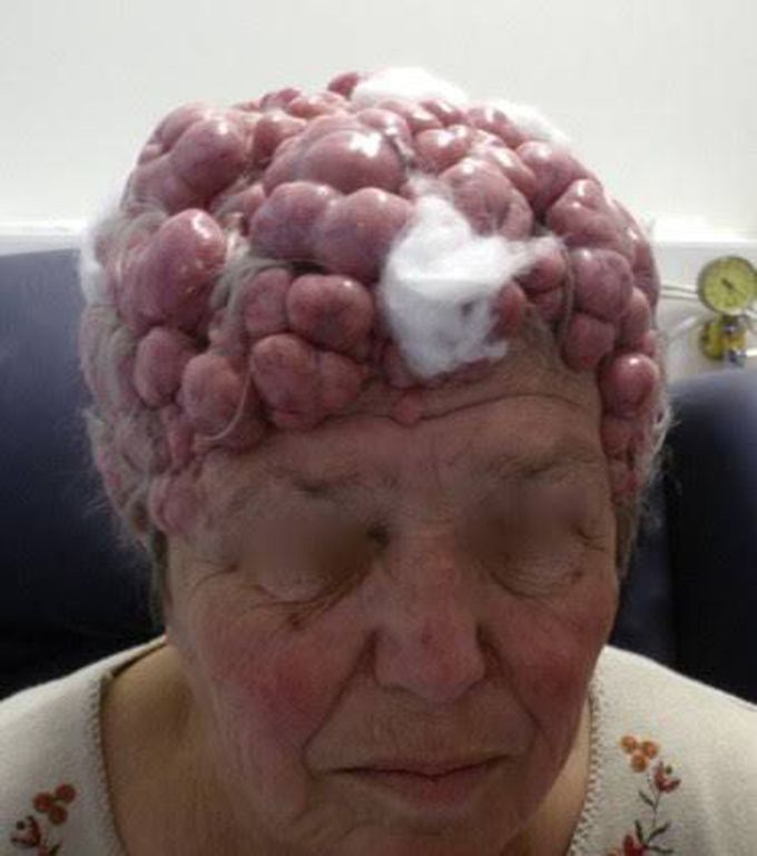 TURBAN TUMOR