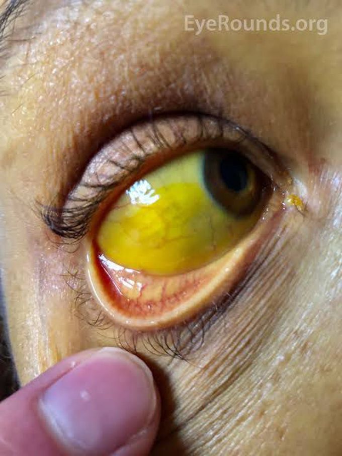 Scleral Icterus Medizzy 